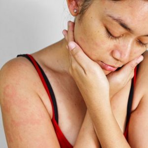 B•O•N Woman Suffering From Sensitive Skin Conditions